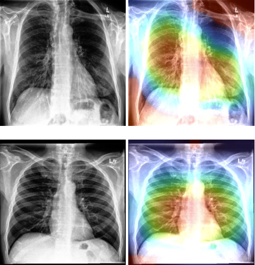 Chest X-Rays